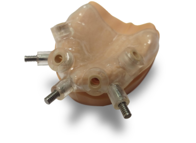 SOFT TISSUE-SUPPORTED SURGICAL GUIDE