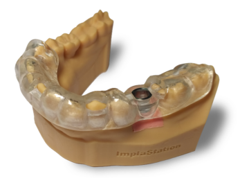 TEETH-SUPPORTED SURGICAL GUIDE