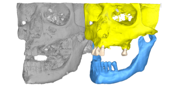 SEGMENTATION DICOM to STL